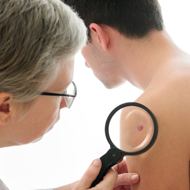 Ne hagyd, hogy terjedjen, szüntesd meg végleg! Bőrgyógyász-kozmetológus szakorvos által végzett szemölcseltávolítás