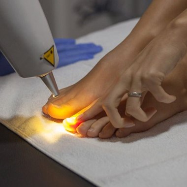Körömgomba-megszüntető lézeres kezelés kézre vagy lábra.