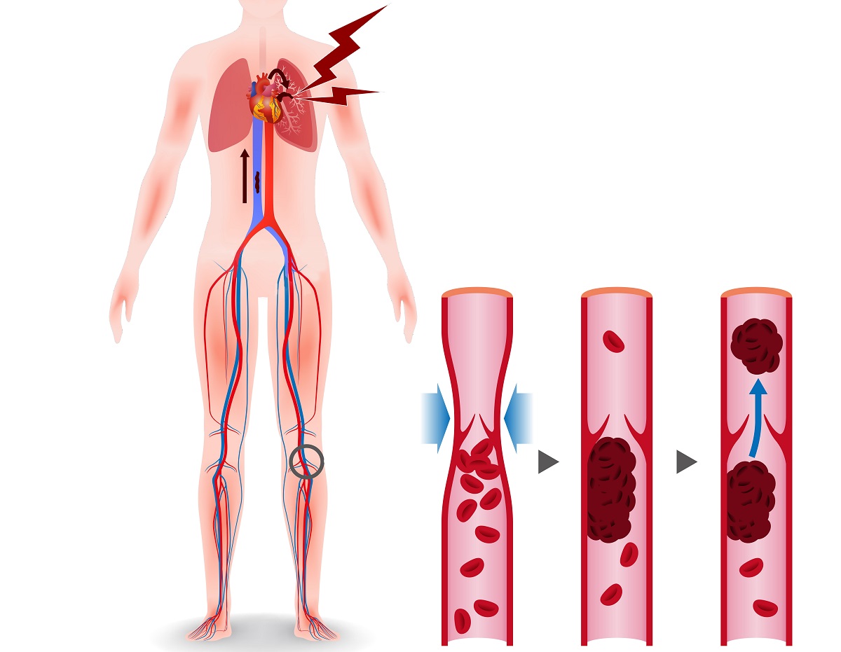 Lábfájás: visszeresség, vagy trombózis?