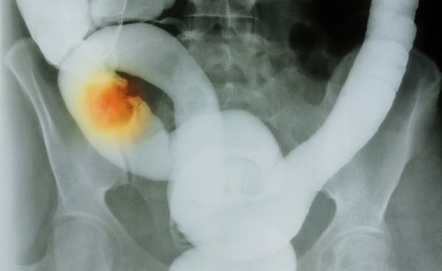 Ne a véged legyen a véged - avagy a vastagbélrákról