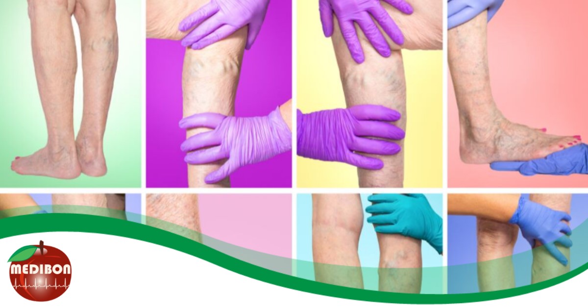 2020. március 19 Országos Érszűkületi Nap - Ingyenes szűrésekkel ellenőriztetheted a lábaidat! Frissítés, 03.09: ELMARAD!