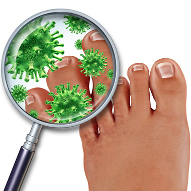 Napjaink leghatékonyabb körömgomba-irtó megoldása: 2 alkalom eredményes lézeres kezelés 90% kedvezménnyel!