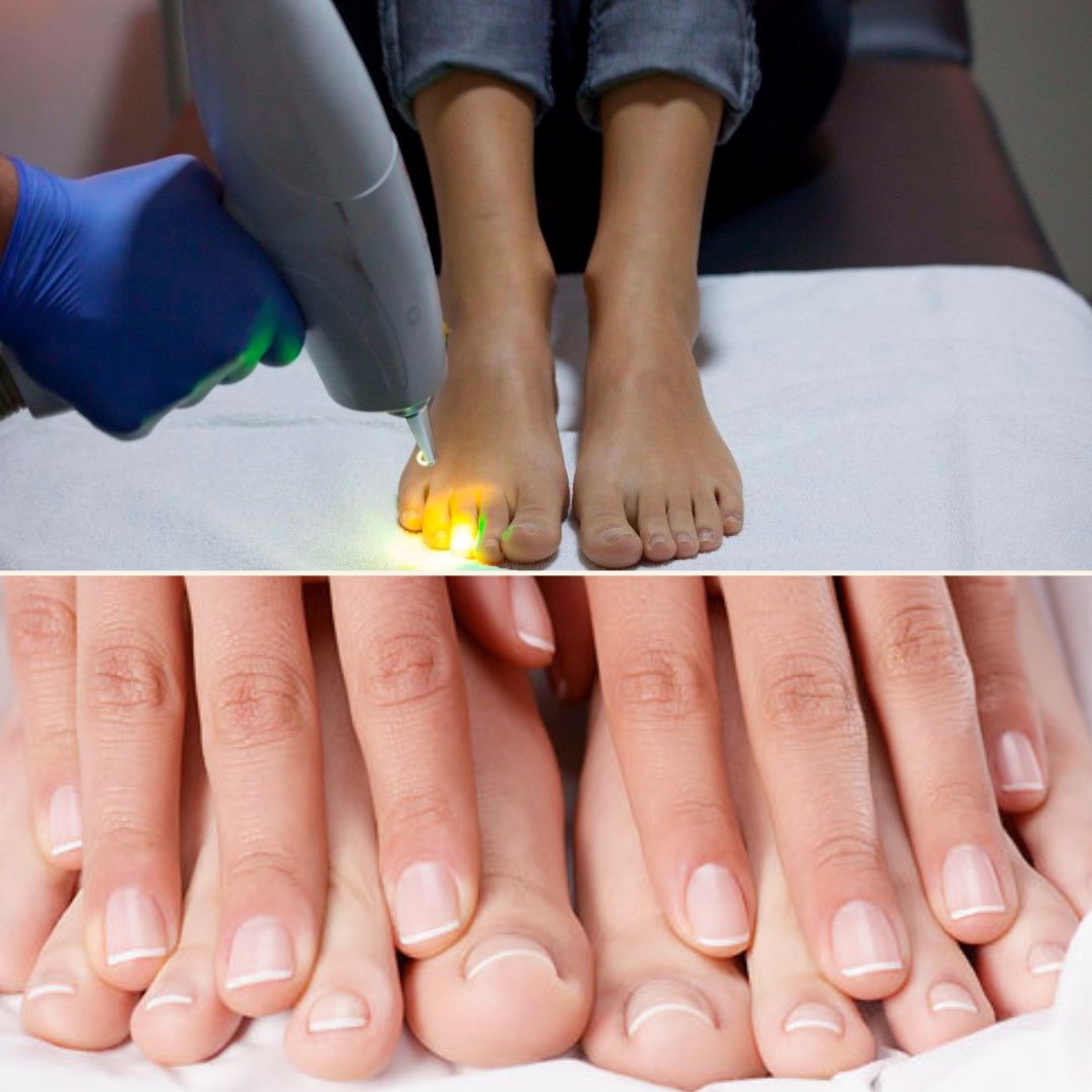 Lézeres körömgomba megszüntető kezelés