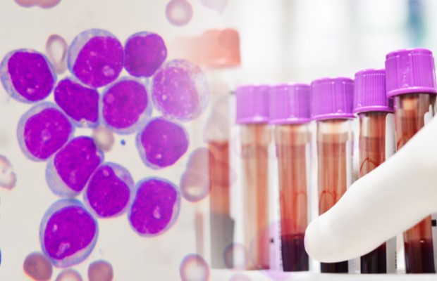 Előrelépés a felnőttkori leukémia kezelésében - hála a magyar tudósok munkájának is