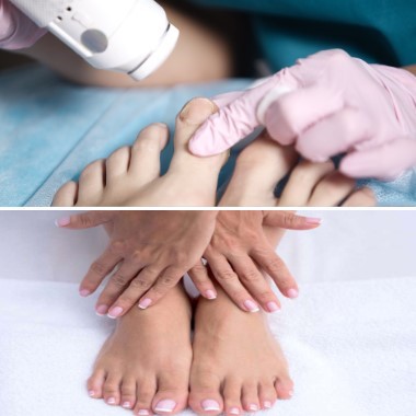 Lézeres körömgomba megszüntető kezelés kézre / lábra