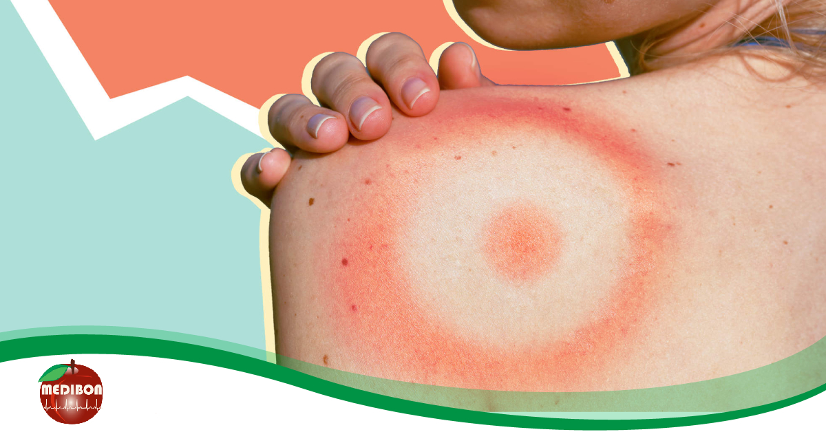 Lyme-kór:&nbsp;miért kezelik félre sokszor?