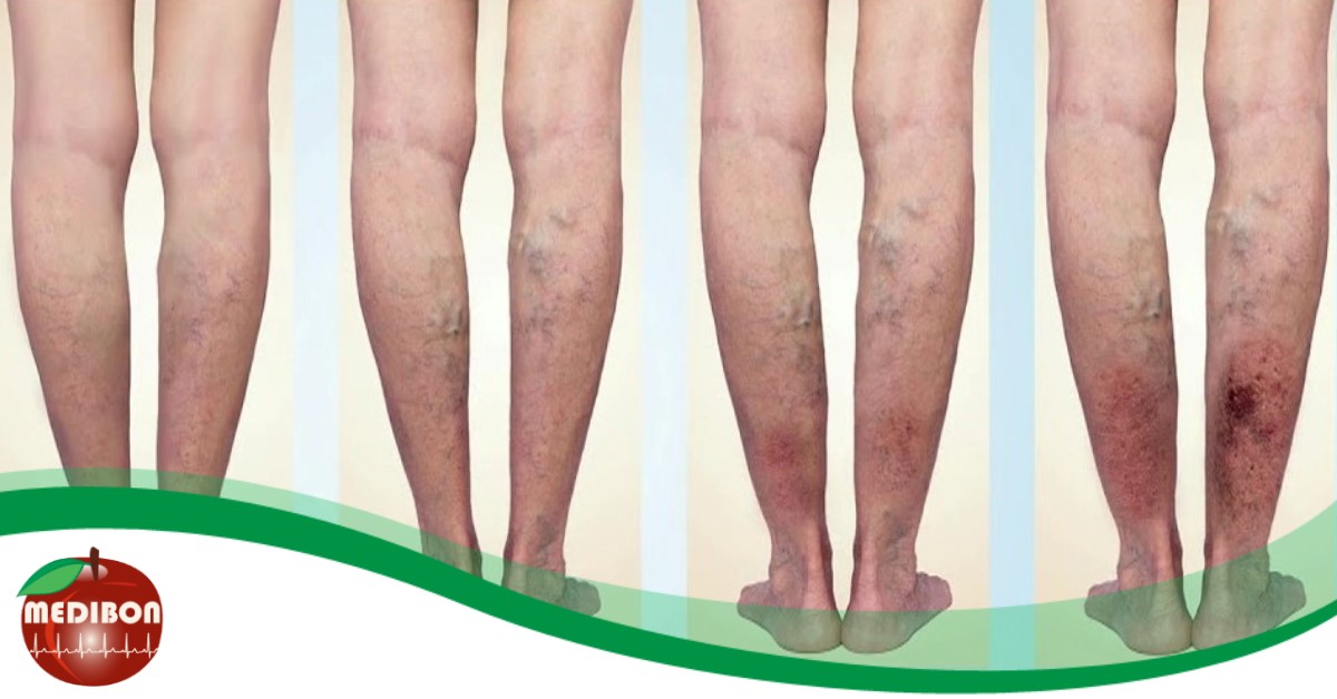 Vedd komolyan: a visszeresség&nbsp;végzetessé is válhat