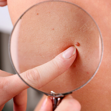 Anyajegy- és melanoma szűrése megelőző és utólagos konzultációval