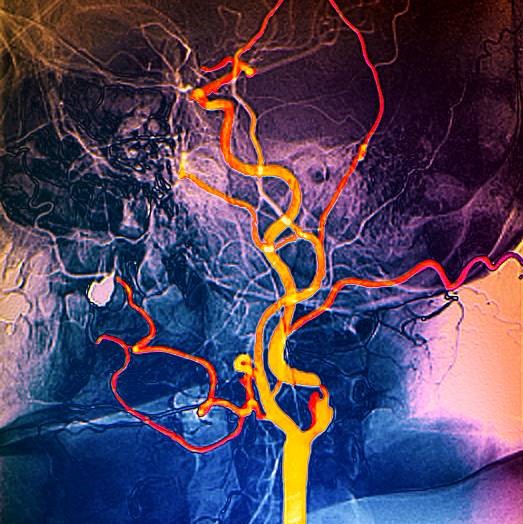 Nyaki erek color Doppler ultrahang vizsgálata radiológus szakorvossal