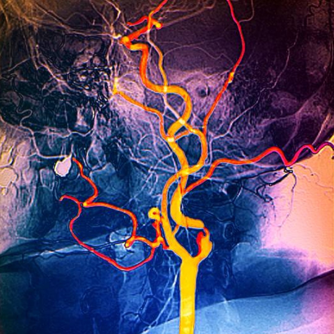 Nyaki erek color Doppler ultrahang vizsgálata radiológus szakorvossal