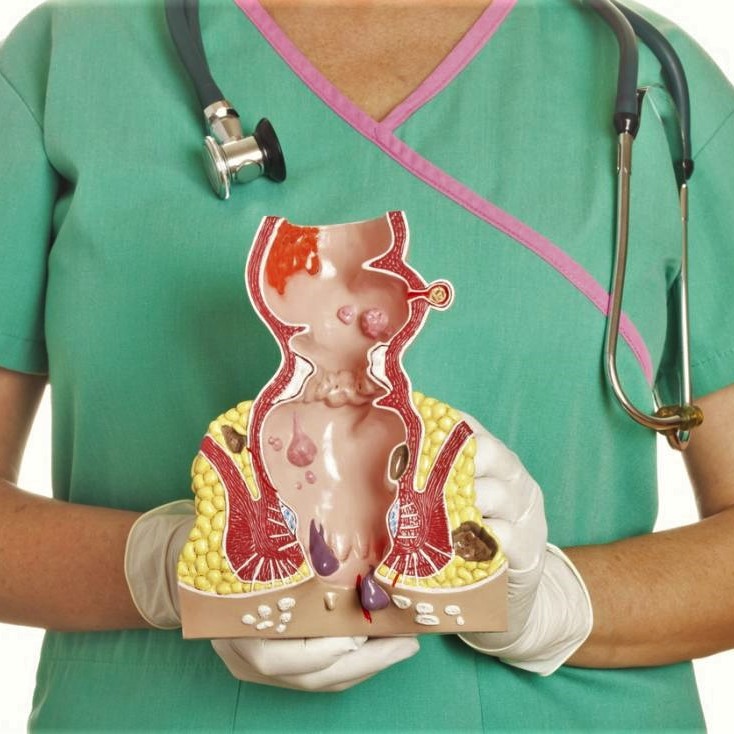 Proktológiai vizsgálat aranyérpanaszok orvoslására és végbélrák megelőző állapotok szűrésére