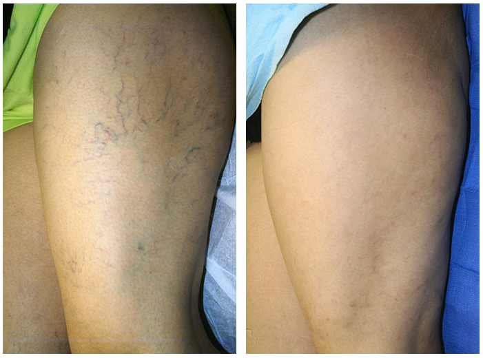 Állj készen a jó időre, a rövid ruhákra: Seprűvéna kezelés mind a kettő teljes lábon, professzionális E-light technológiával, a vonzó lábakért