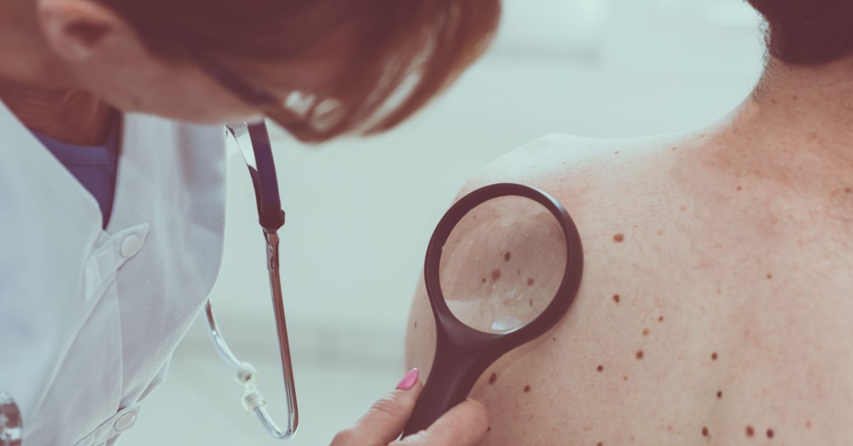 Vigyázz! Fénysebességgel nő a melanomás esetek száma