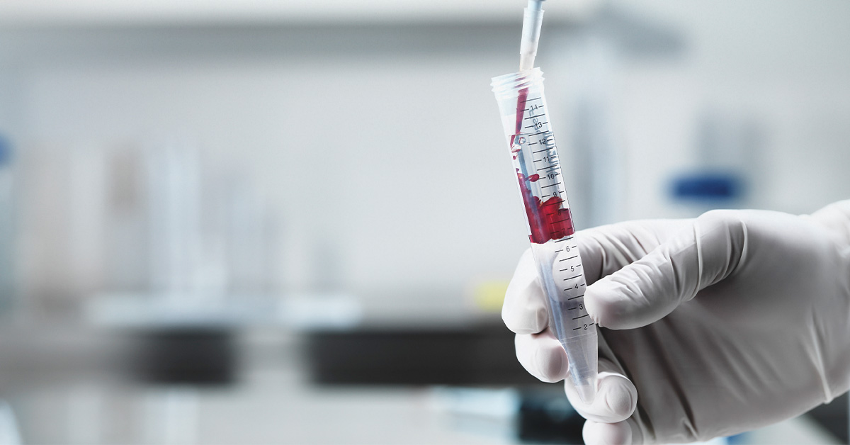 Szívbetegséget kockáztatsz? Mutatjuk az erre utaló laboreredményeket