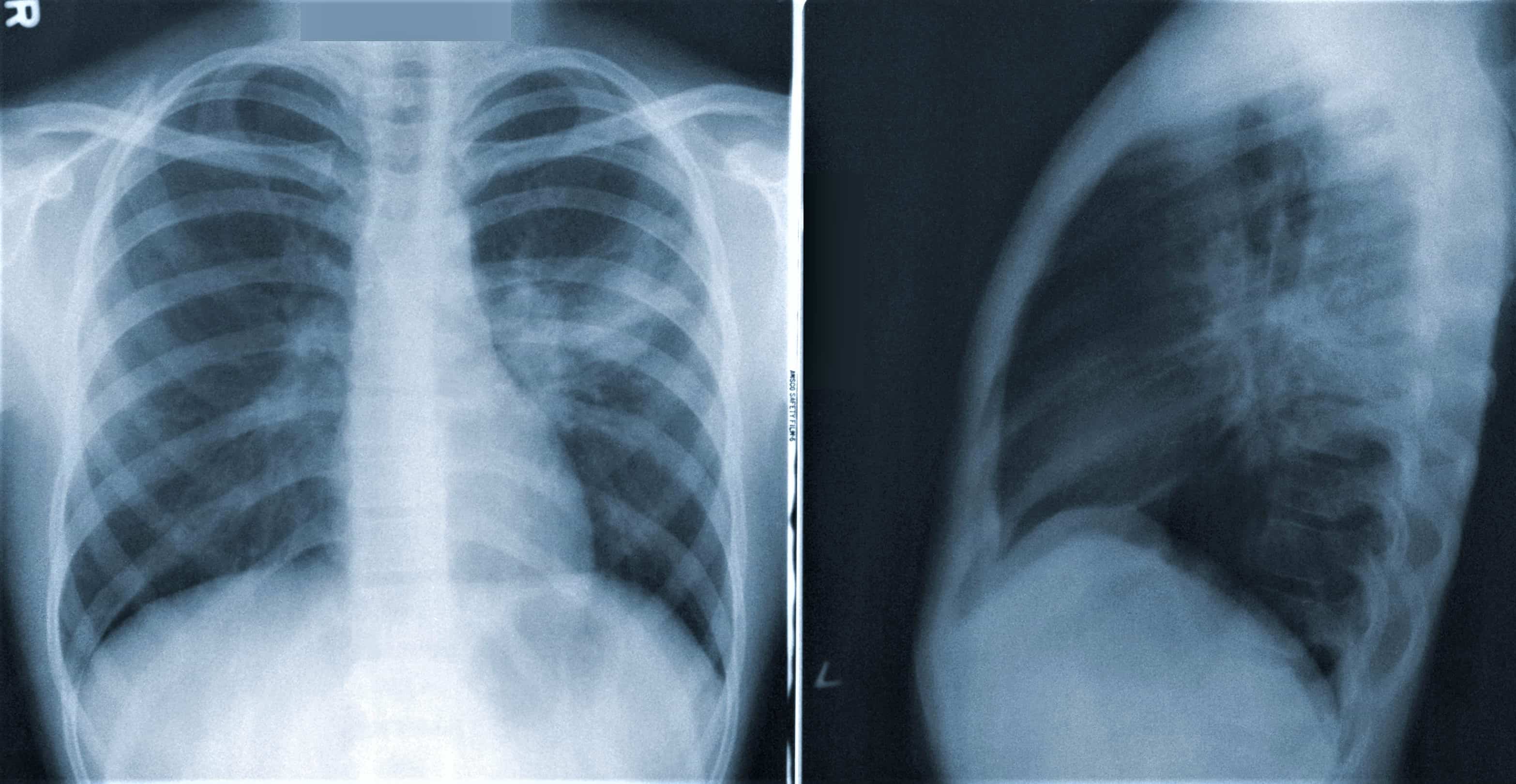 Így enyhítsd a tügyőgyulladás tüneteit