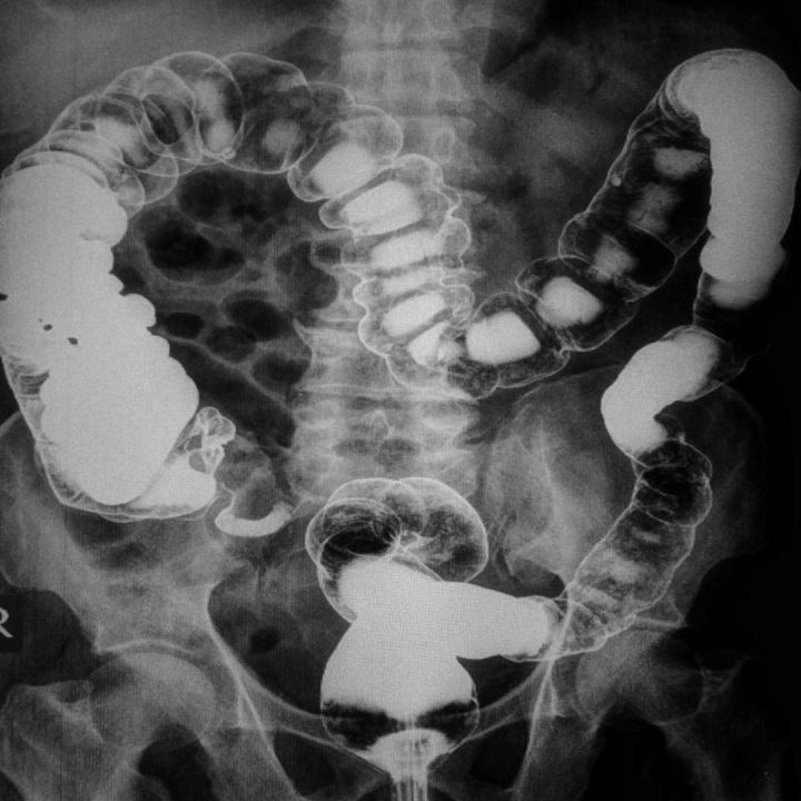 Vastagbélrák kimutatására szolgáló kétlépcsős labor vizsgálat