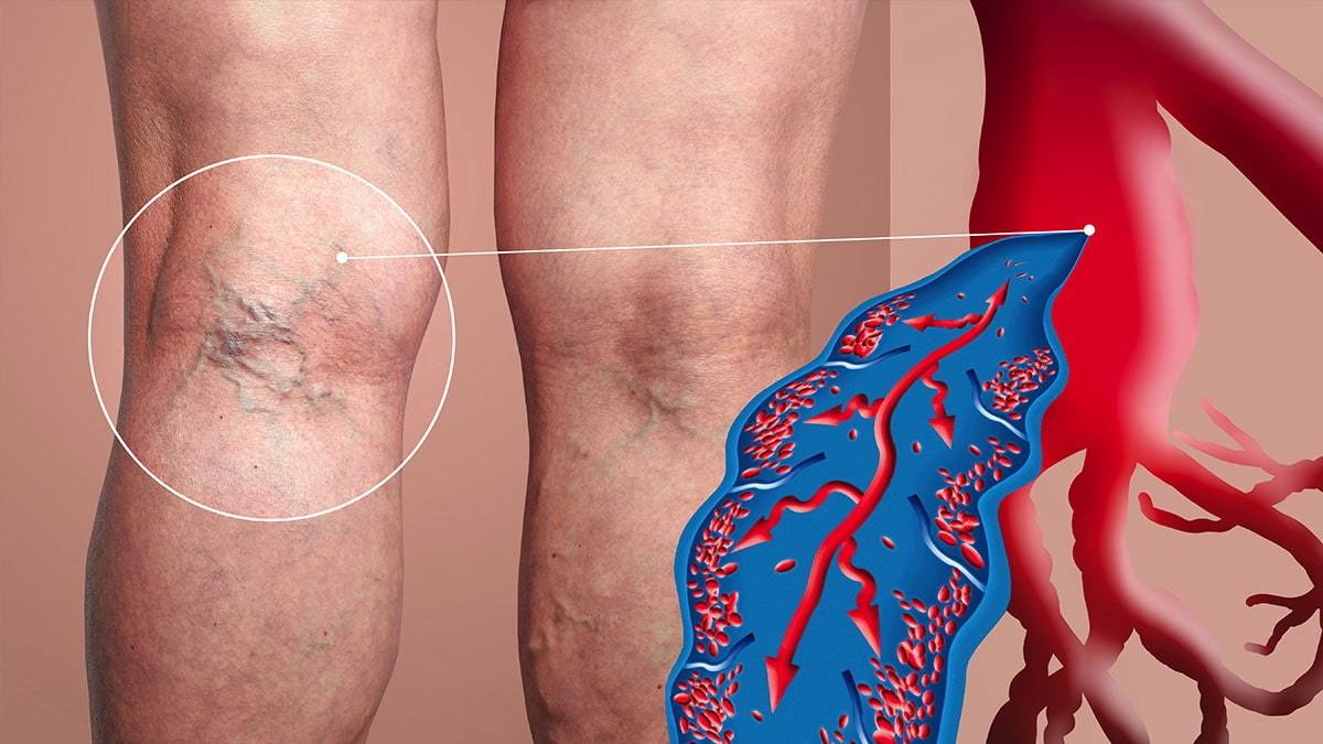 Május 15 és 21. között zajlik a Vénák Hete: a&nbsp;30 felettiek közel fele tapasztalja a tüneteket, mégis csak az ötödük kezelteti a visszérbetegségét