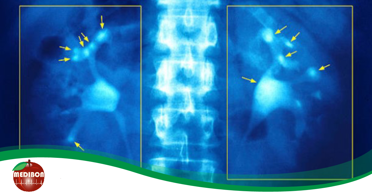 Láss a vesédbe:&nbsp;a vesebetegségek tünetei, megelőzésük