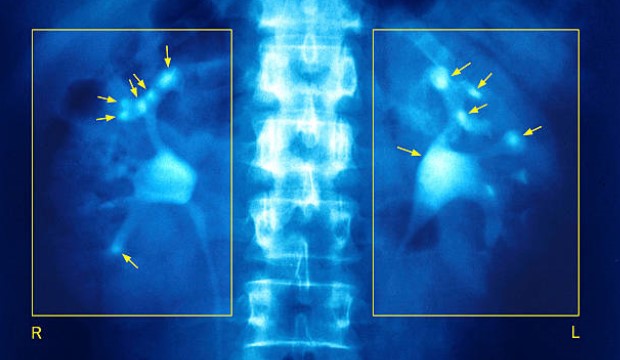 Láss a vesédbe:&nbsp;a vesebetegségek tünetei, megelőzésük